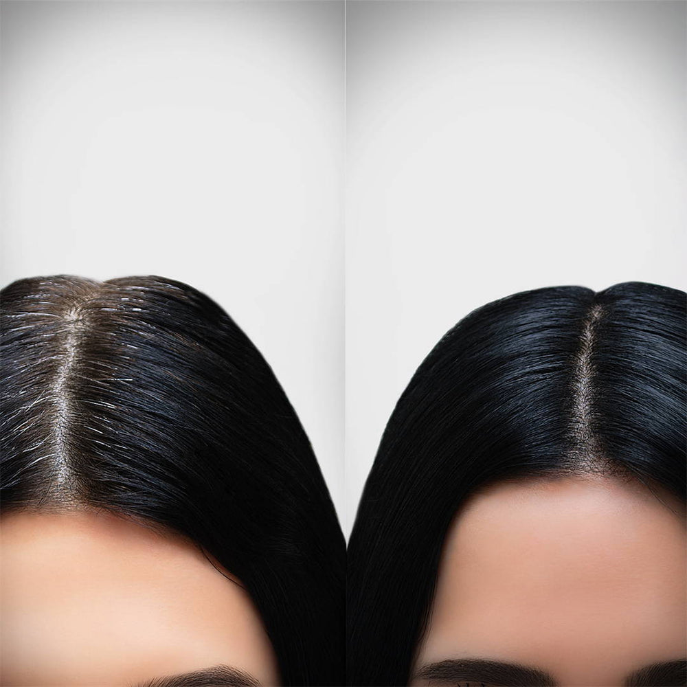 Scalpsense Oil Out combo pack of 5 with shampoo, conditioner, and scalp care solutions for oily scalp and refreshed hair